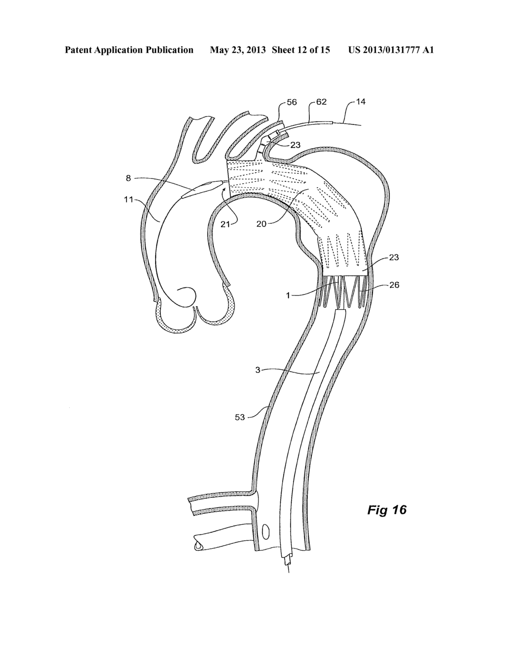 BRANCH STENT GRAFT DEPLOYMENT AND METHOD - diagram, schematic, and image 13