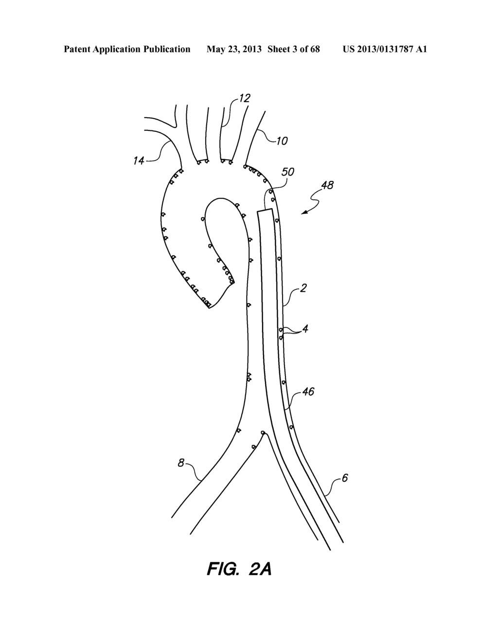 METHOD FOR DEPLOYING A DEVICE TO A DISTAL LOCATION ACROSS A DISEASED     VESSEL - diagram, schematic, and image 04