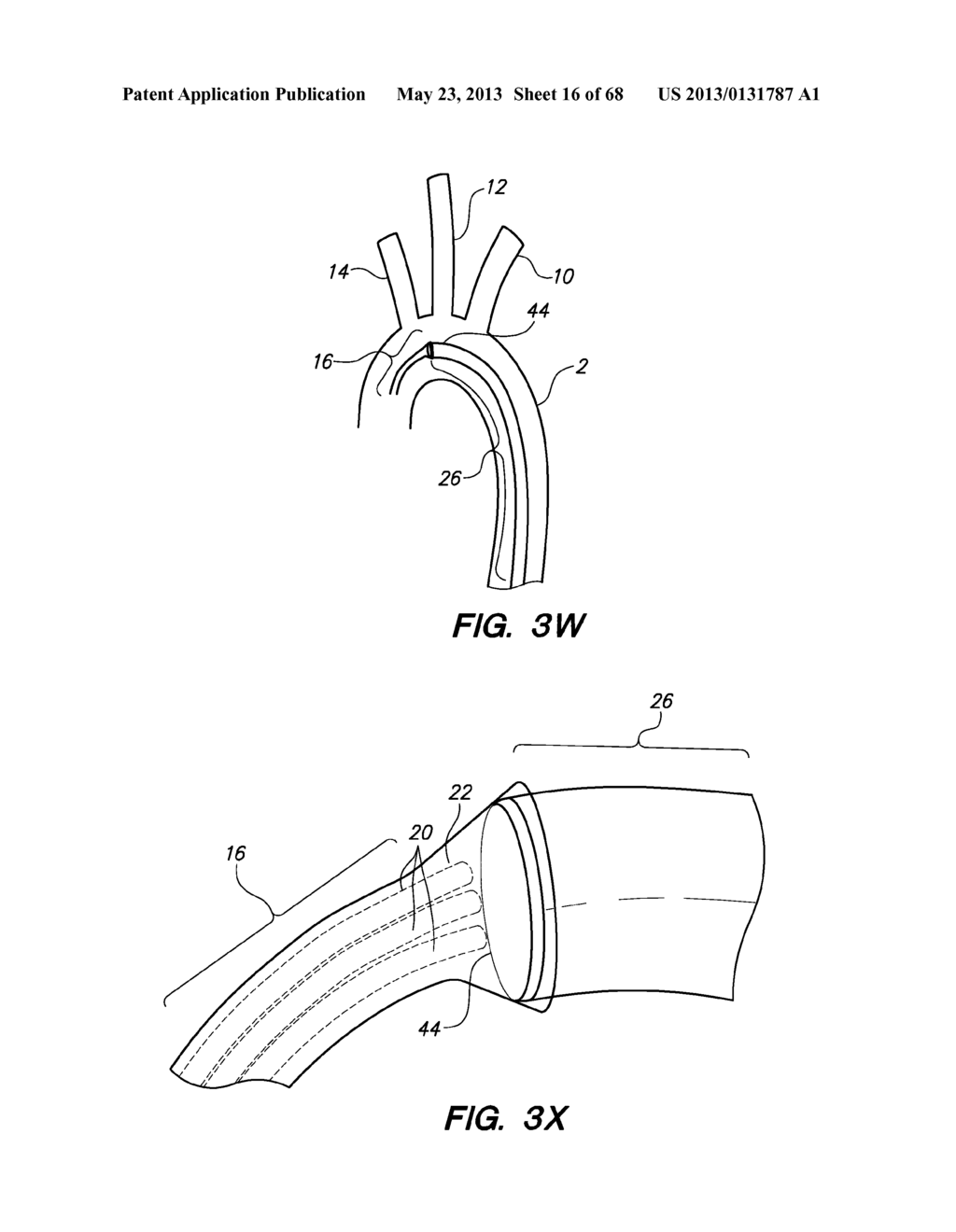 METHOD FOR DEPLOYING A DEVICE TO A DISTAL LOCATION ACROSS A DISEASED     VESSEL - diagram, schematic, and image 17