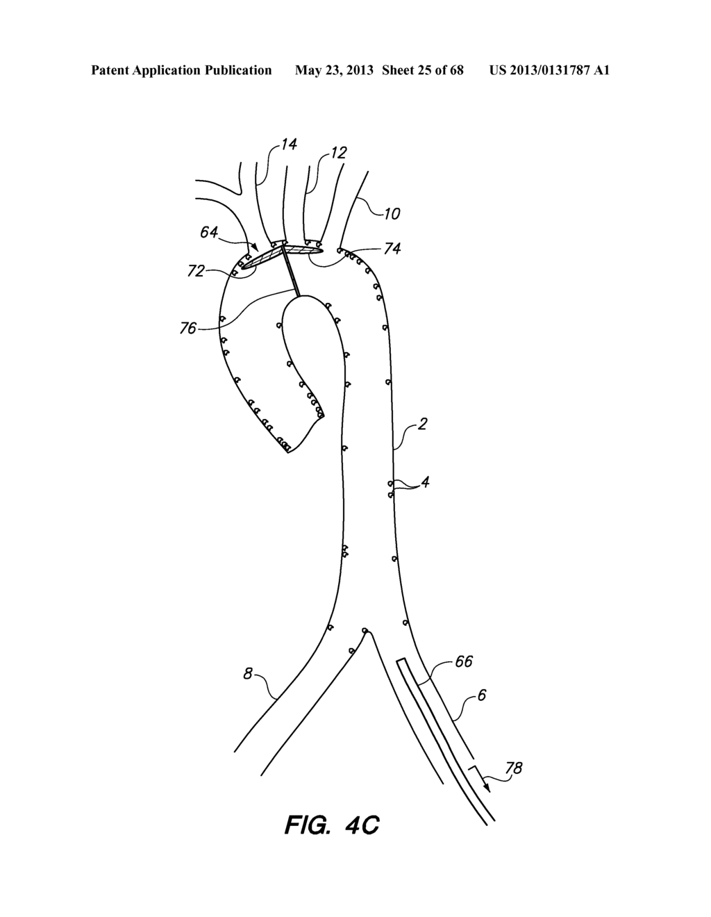 METHOD FOR DEPLOYING A DEVICE TO A DISTAL LOCATION ACROSS A DISEASED     VESSEL - diagram, schematic, and image 26