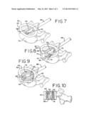 APPARATUS AND METHOD FOR TREATING BONE diagram and image