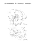 TIBIAL BEARING COMPONENT FOR A KNEE PROSTHESIS WITH IMPROVED ARTICULAR     CHARACTERISTICS diagram and image