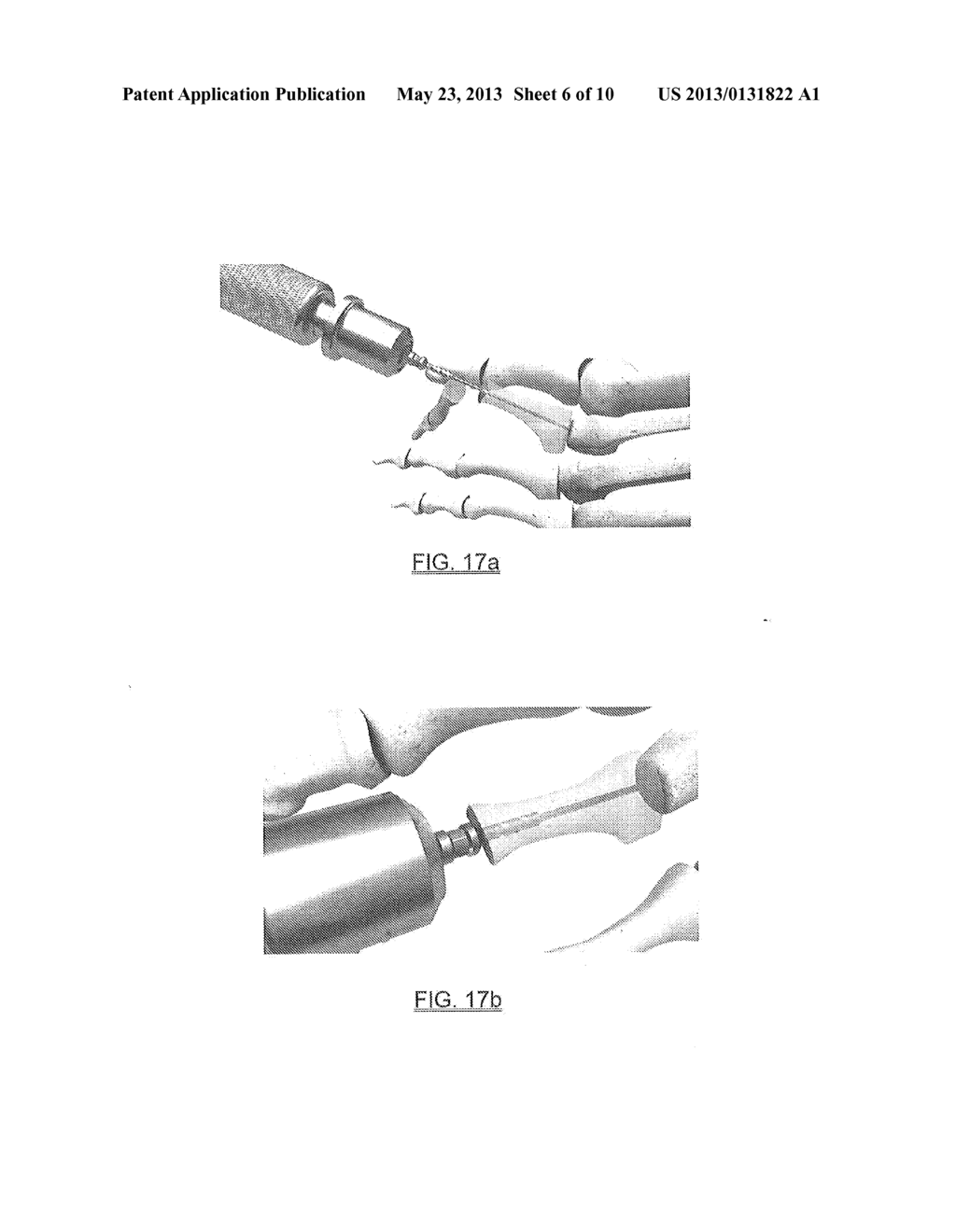 HAMMERTOE IMPLANT - diagram, schematic, and image 07