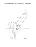 Dental Tools for Photo-Curing of Dental Fillings diagram and image