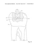 Dental Tools for Photo-Curing of Dental Fillings diagram and image