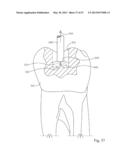 Dental Tools for Photo-Curing of Dental Fillings diagram and image