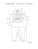 Dental Tools for Photo-Curing of Dental Fillings diagram and image