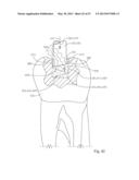 Dental Tools for Photo-Curing of Dental Fillings diagram and image