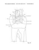 Dental Tools for Photo-Curing of Dental Fillings diagram and image