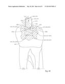 Dental Tools for Photo-Curing of Dental Fillings diagram and image