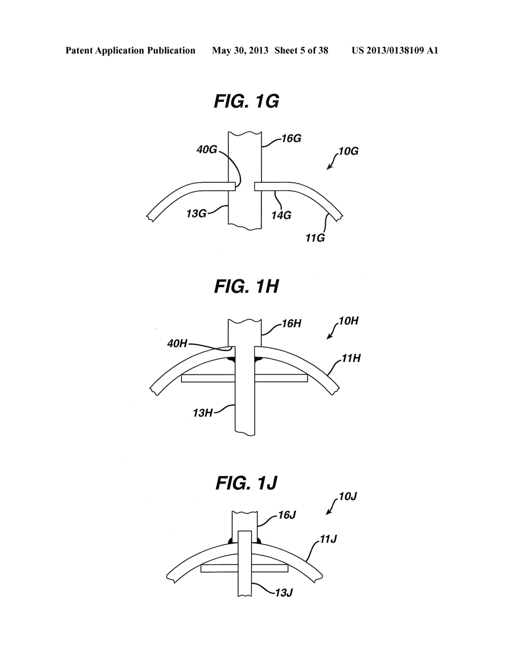 Arthroplasty Instruments and Associated Method - diagram, schematic, and image 06