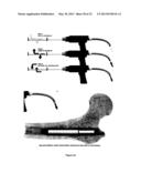 DEVICES FOR ADAPTING BONE diagram and image