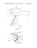 Methods And Devices For Endoscopically Creating An Anastomosis diagram and image