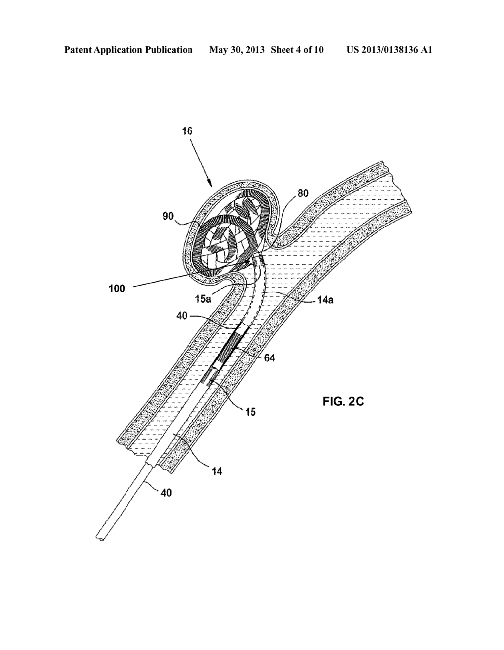 POSITIONING AND DETACHING IMPLANTS - diagram, schematic, and image 05