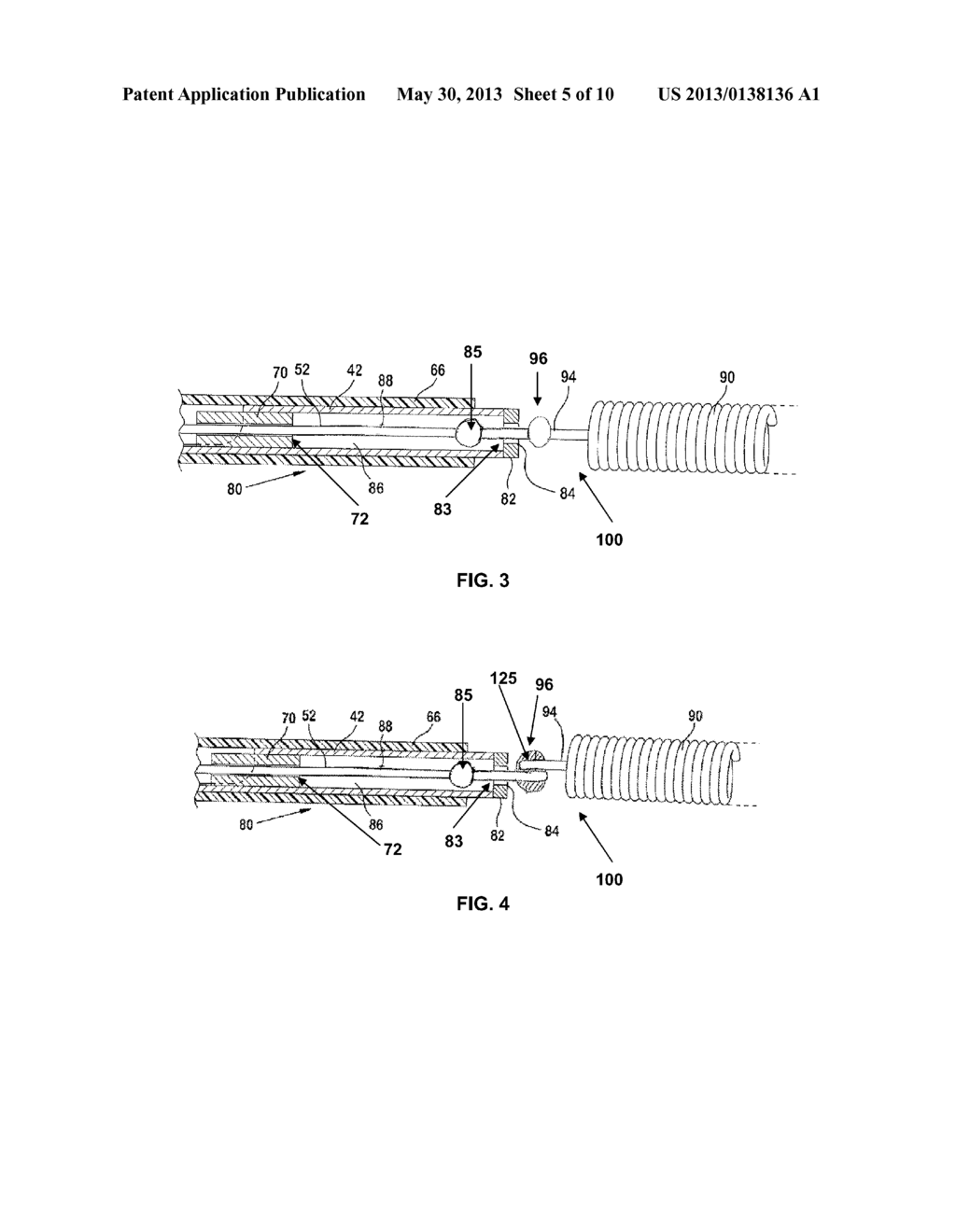 POSITIONING AND DETACHING IMPLANTS - diagram, schematic, and image 06