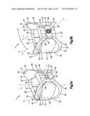 Intervertebral Implant with Blades for Connecting to Adjacent Vertebral     Bodies diagram and image