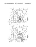 Intervertebral Implant with Blades for Connecting to Adjacent Vertebral     Bodies diagram and image