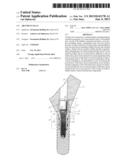 ABUTMENT INLAY diagram and image