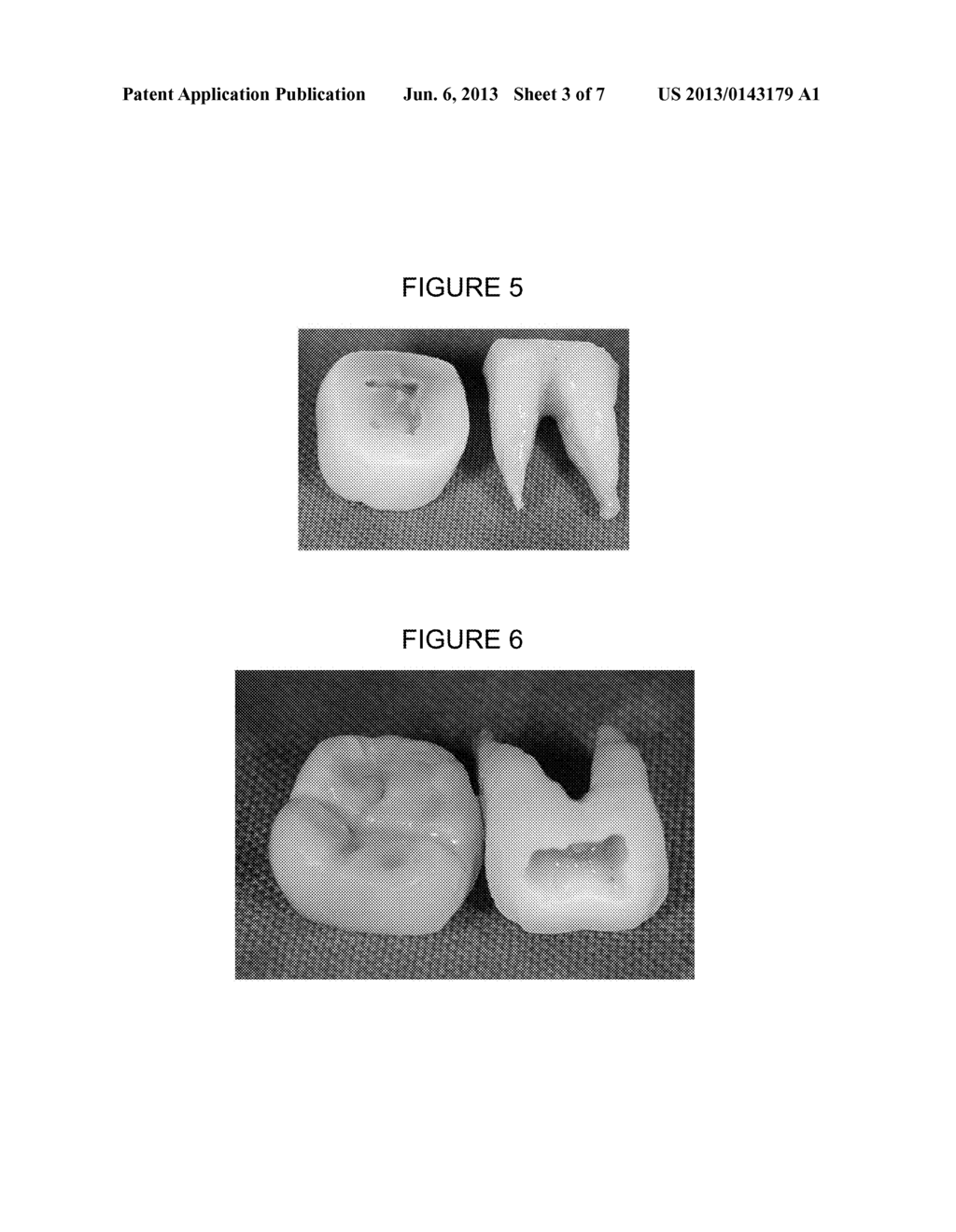 METHOD FOR PROCESSING BONE GRAFT MATERIAL USING TEETH, AND BONE GRAFT     MATERIAL PROCESSED THEREBY - diagram, schematic, and image 04