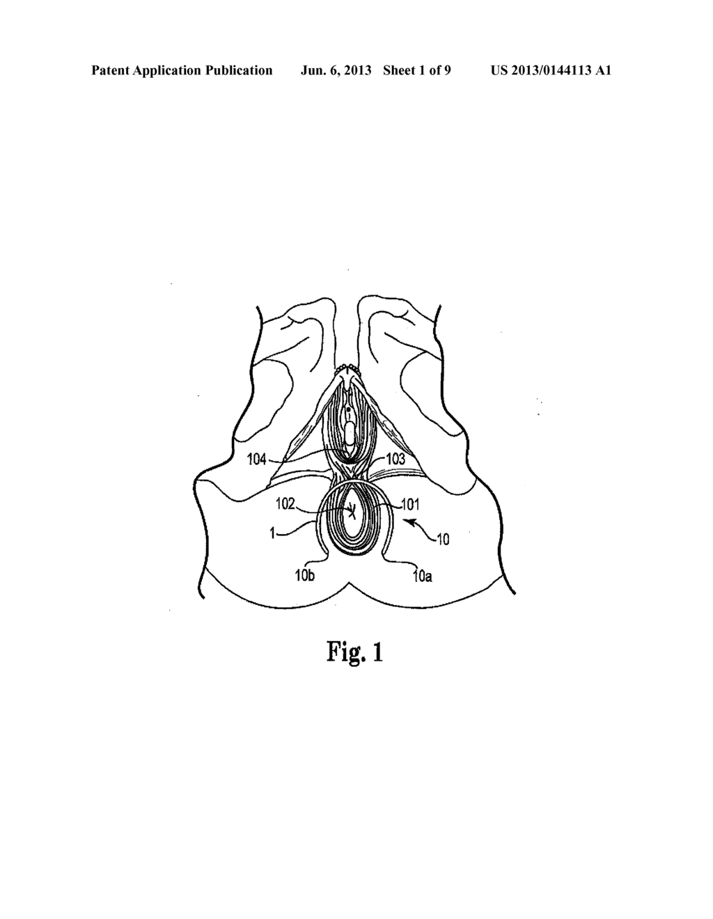 METHOD OF TREATING ANAL INCONTINENCE - diagram, schematic, and image 02