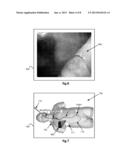 METHOD AND SYSTEM FOR PROVIDING VISUAL GUIDANCE TO AN OPERATOR FOR     STEERING A TIP OF AN ENDOSCOPIC DEVICE TOWARD ONE OR MORE LANDMARKS IN A     PATIENT diagram and image