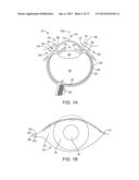 OCULAR INSERT APPARATUS AND METHODS diagram and image