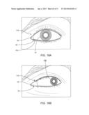 OCULAR INSERT APPARATUS AND METHODS diagram and image