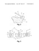 ADHESIVE DELIVERY DEVICES, SYSTEMS AND METHODS diagram and image