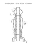 STRICTURE TREATMENT AND DRAINAGE CATHETER diagram and image