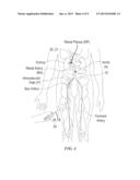 TREATMENT OF POLYCYSTIC OVARY SYNDROME USING RENAL NEUROMODULATION AND     ASSOCIATED SYSTEMS AND METHODS diagram and image