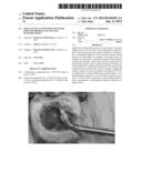 SINGLE-UNIT CUTTING HEAD SYSTEMS FOR SAFE REMOVAL OF NUCLEUS PULPOSIS     TISSUE diagram and image