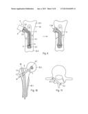 METHOD AND DEVICE FOR PRODUCING AN ANCHORAGE IN HUMAN OR ANIMAL TISSUE diagram and image