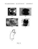 DISCECTOMY KITS WITH AN OBTURATOR, GUARD CANNULA diagram and image