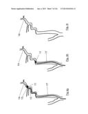 CLOT CAPTURE SYSTEMS AND ASSOCIATED METHODS diagram and image