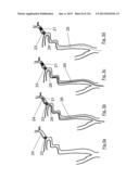 CLOT CAPTURE SYSTEMS AND ASSOCIATED METHODS diagram and image