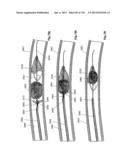 CLOT CAPTURE SYSTEMS AND ASSOCIATED METHODS diagram and image