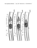 CLOT CAPTURE SYSTEMS AND ASSOCIATED METHODS diagram and image