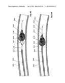 CLOT CAPTURE SYSTEMS AND ASSOCIATED METHODS diagram and image