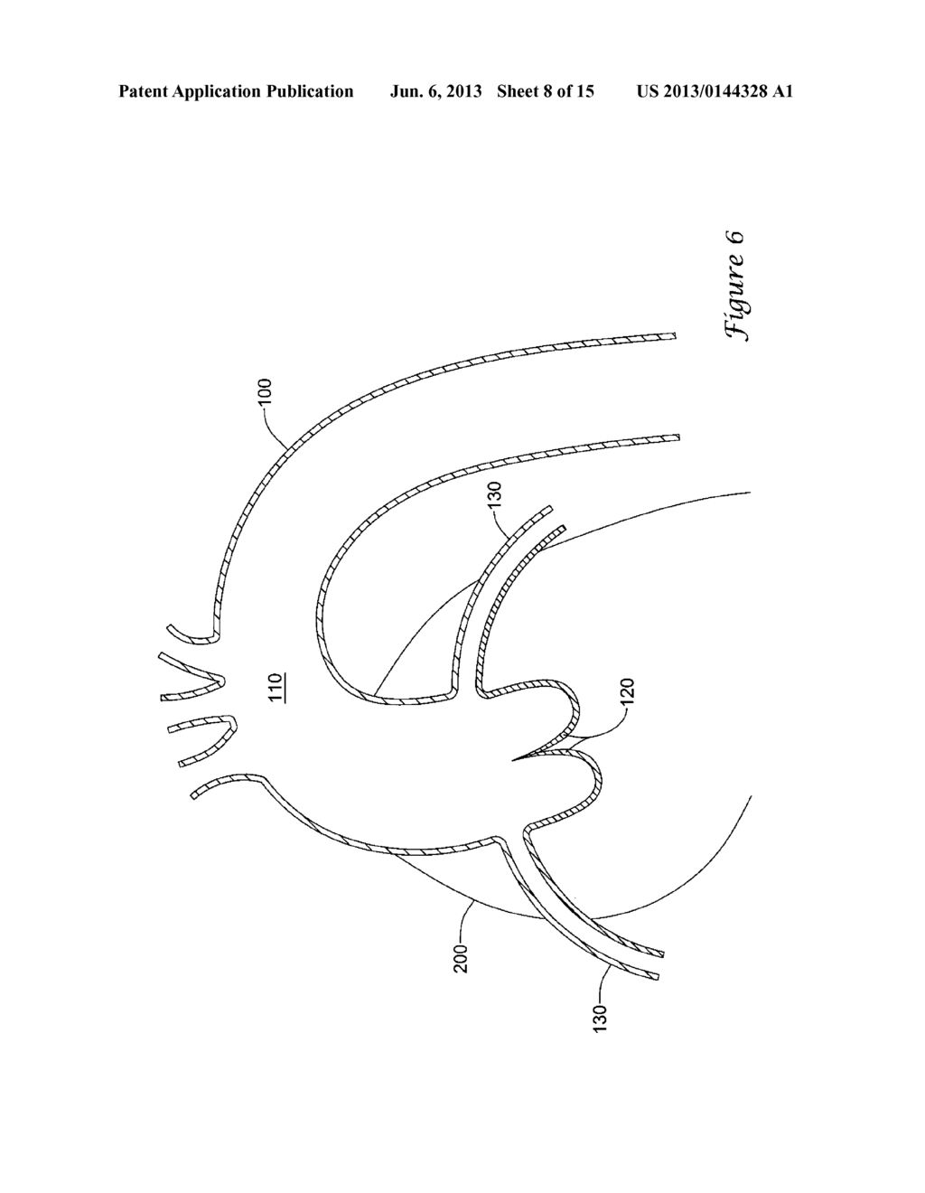 EXPANDING DISTAL SHEATH WITH COMBINED EMBOLIC PROTECTION - diagram, schematic, and image 09