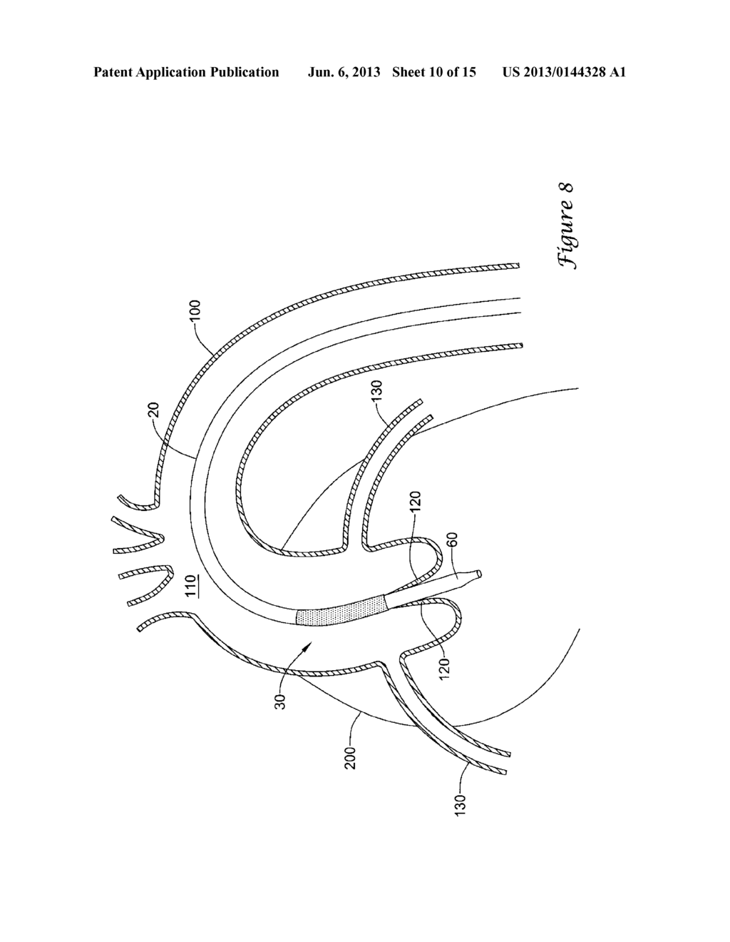 EXPANDING DISTAL SHEATH WITH COMBINED EMBOLIC PROTECTION - diagram, schematic, and image 11