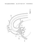 EXPANDING DISTAL SHEATH WITH COMBINED EMBOLIC PROTECTION diagram and image