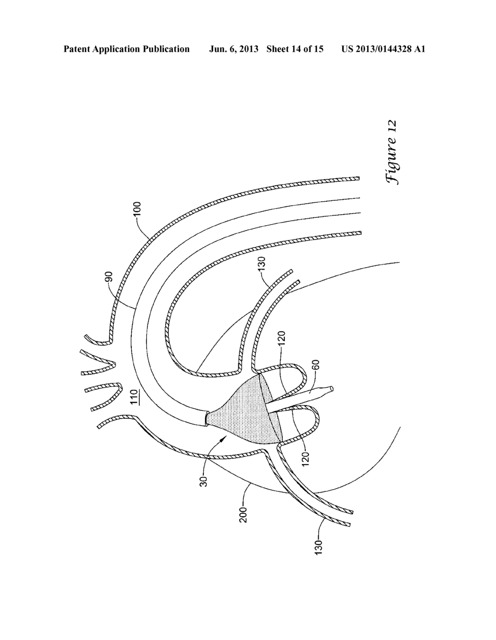 EXPANDING DISTAL SHEATH WITH COMBINED EMBOLIC PROTECTION - diagram, schematic, and image 15