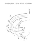 EXPANDING DISTAL SHEATH WITH COMBINED EMBOLIC PROTECTION diagram and image