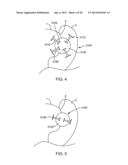 Sacroiliac Fusion Cage diagram and image