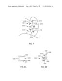 Sacroiliac Fusion Cage diagram and image