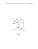 Sacroiliac Fusion Cage diagram and image