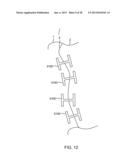 Sacroiliac Fusion Cage diagram and image