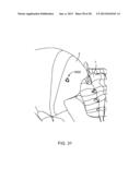 Sacroiliac Fusion Cage diagram and image