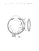 Retinal Prosthesis diagram and image