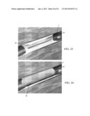 ENDOLUMINAL DEVICE AND METHOD diagram and image